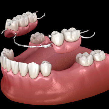 Full Denture Care Made Easy: Tips for a Healthy Smile at Emerald Dental Spa, Union, NJ