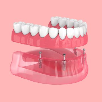 How Long Does Recovery Take After All-on-4 Implant Surgery?